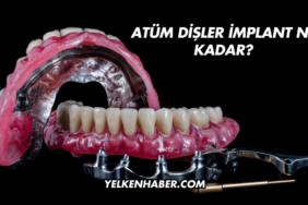 Tüm Dişler İmplant Ne Kadar?